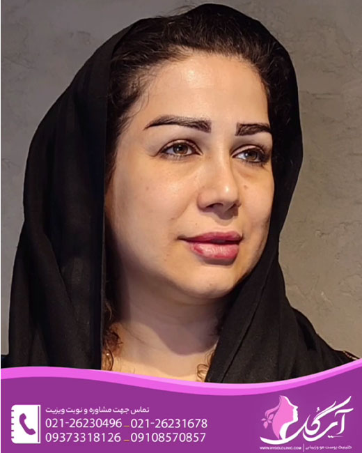 چه افرادی باید عمل کاشت ابرو طبیعی انجام دهند؟