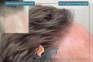 مایکروپوینت مو؛ طریقه اجرا، معایب و مقایسه آن با کاشت مو