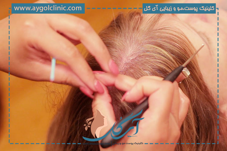 عمل کاشت موی طبیعی در کلینیک آی گل