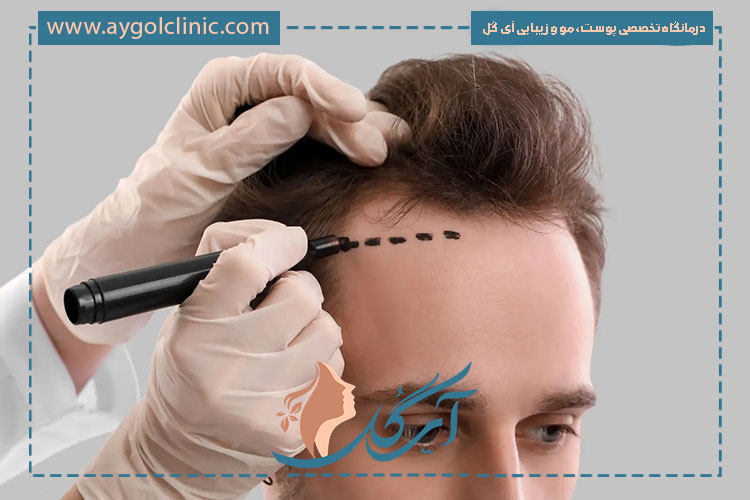 راهنمای کامل مراحل کاشت مو و نکات کلیدی موفقیت آن