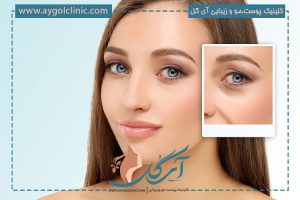 جراحی زیبایی چشم؛ انواع، تکنیک عمل، مزایا و عوارض 