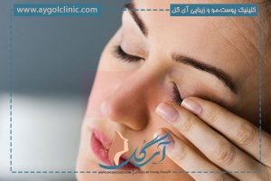 علت و درمان تورم ناگهانی پلک بالا با روش‌های خانگی و پزشکی