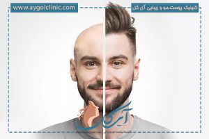 قیمت کاشت هر تار مو؛ عوامل موثر + انتخاب بهترین کلینیک