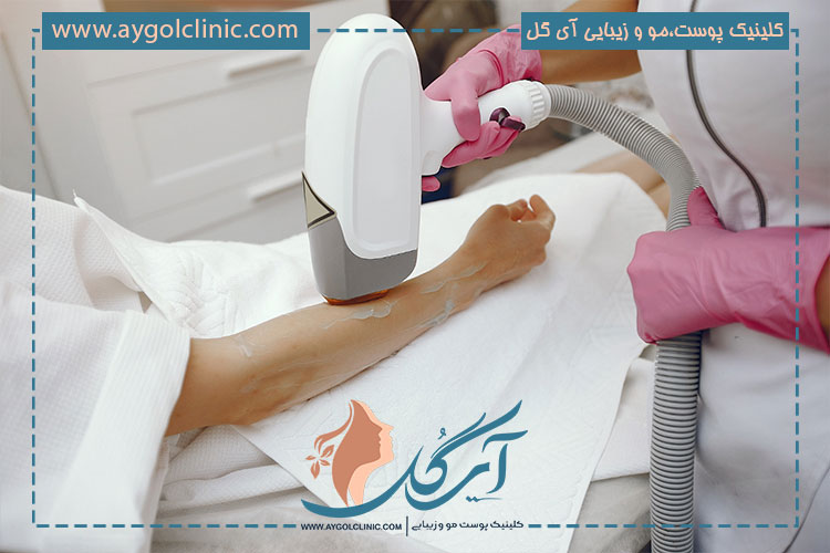 مراقبت های پس از درمان لیزر موهای زائد