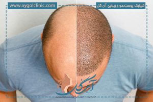 راهنمای کامل مراحل کاشت مو و نکات کلیدی موفقیت آن