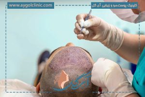 همه چیز درباره شایعترین عوارض کاشت مو و روشهای پیشگیری