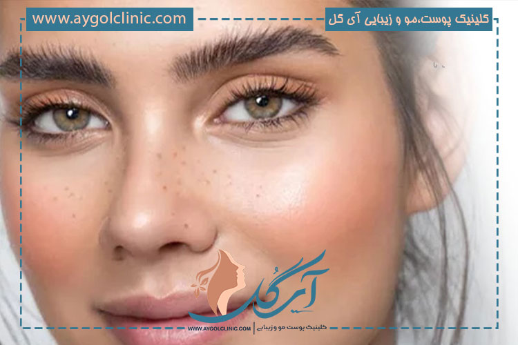 محل اهدای فولیکول مو برای کاشت ابرو