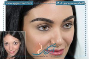 برای کاشت ابرو از کجا مو برمیدارند؟