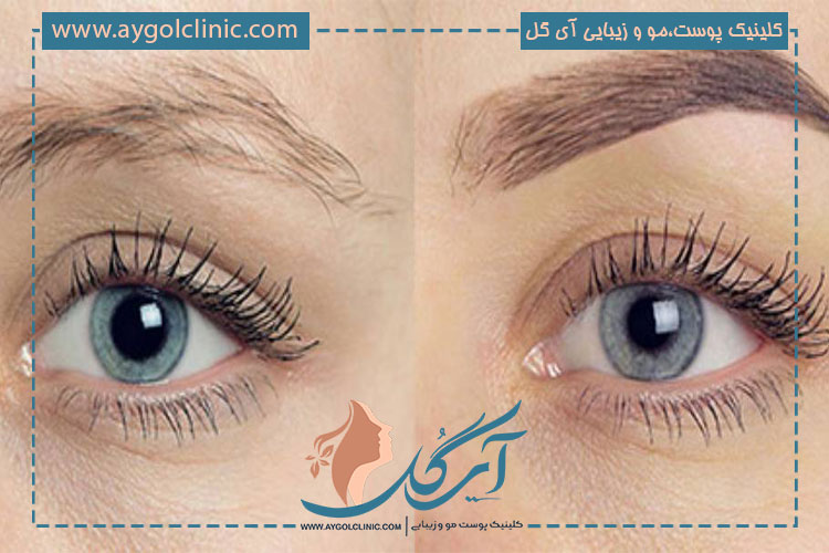 نکات مرتبط با انتخاب بهترین کلینیک کاشت ابرو