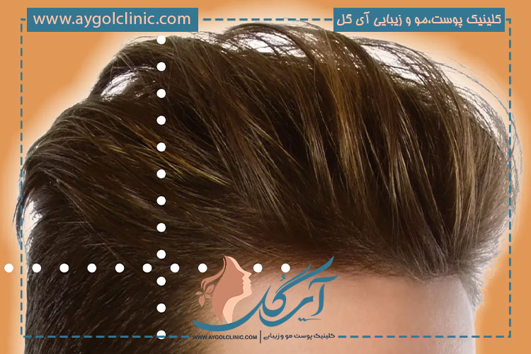 گرافت مو؛ تعداد مورد نیاز آن برای عمل کاشت مو