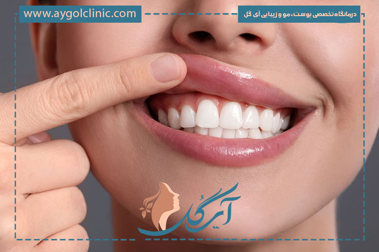 افزایش اعتماد به نفس با تأثیر بوتاکس لبخند لثه‌ای در بهبود ظاهر لبخند.