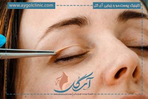 نحوه تشخیص افتادگی پلک (پتوز) | بررسی علائم و دلایل ایجاد آن