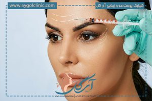 درمان سریع افتادگی پلک بعد از بوتاکس
