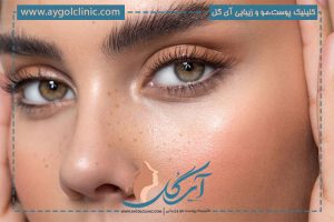 آشنایی با علت سیخ شدن ابرو بعد از کاشت و راه های درمان این مشکل