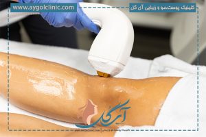 برای لیزر دستگاه شاتی بهتره یا رولی؟