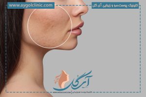 3 کاربرد مهم لیزر فراکشنال + نحوه عملکرد