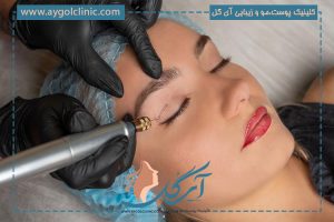 آیا پلکسر چشم میتواند جایگزین عمل جراحی شود؟