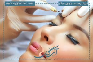 پیوند ابرو چیست ، چگونه انجام می شود و مراحل آن چیست؟