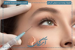 بوتاکس ابرو چگونه است؟ بررسی میزان ماندگاری بوتاکس ابرو