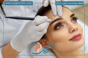 نحوه و مراحل کاشت ابرو؛ از طراحی ابرو تا پیوند گرافت‌ها
