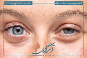 افتادگی پلک بعد از بوتاکس چقدر طول میکشد؟