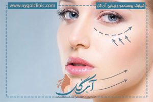 آشنایی با اندولیفت، جدیدترین روش جراحی افتادگی پلک و مزایای آن