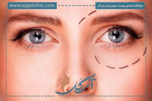 جدیدترین روش جراحی افتادگی پلک چیست و چگونه انجام می‌شود؟