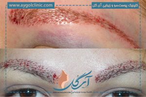 دوره نقاهت کاشت ابرو چه مدت است؟ | 10 نکته مراقبتی