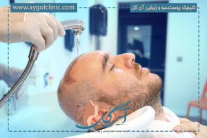 شستشوی سر بعد از کاشت مو چگونه است؟ + رعایت نکات مهم