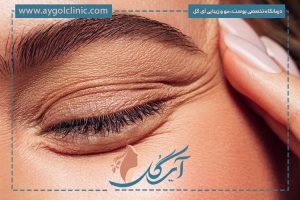 آیا عمل پلک برگشت دارد؟ + نحوه جلوگیری از برگشت عمل پلک