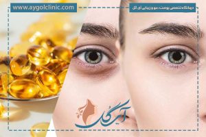 کمبود کدام ویتامین باعث پف زیر چشم میشود؟