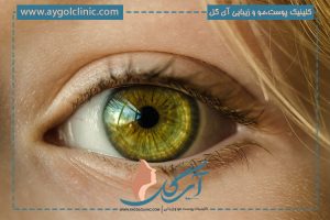 پلک دوتایی چیست؟ آشنایی با جراحی پلک دوتایی و کاربرد آن
