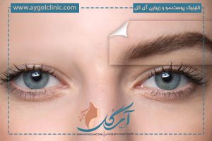 کاشت ابرو برای بیماران خاص چگونه و در چه زمانی امکان پذیر است؟
