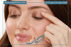 بهترین زمان استفاده از کرم ترمیم کننده بعد از بلفاروپلاستی