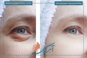 دلیل گوشت اضافه بعد از بلفاروپلاستی چیست؟ + نحوه درمان
