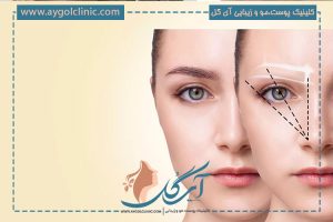 کاشت ابرو به روش FIT | هر آنچه باید بدانید + مزایا، معایب و مراحل