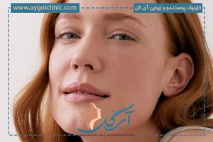 بلفاروپلاستی پف زیر چشم | راه درمان قطعی پف زیر چشم + هزینه 💰