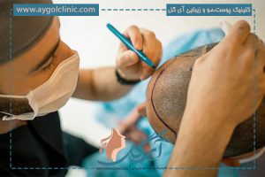 از چه روشهایی برای کاشت مو بدون بانک مو استفاده میشود؟