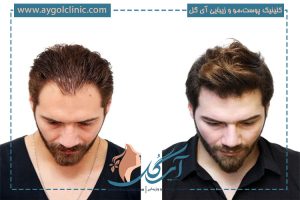 رنگ کردن مو بعد از کاشت مو چه موقع و چگونه‌؟