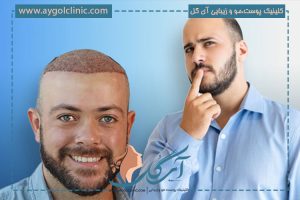 بهترین سن برای کاشت مو: چه زمانی مناسب است؟