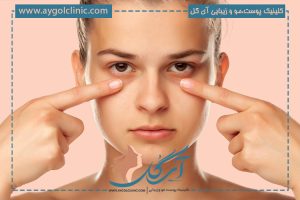 تیرگی زیر چشم: علل، درمان‌ها و راه‌های پیشگیری از آن