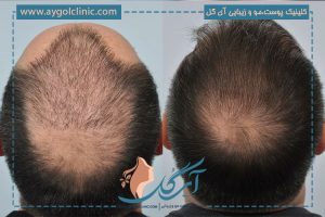 خط رویش مو در کاشت مو به صورت طبیعی  و حرفه ای