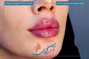 مدل ژل لب عروسکی چاکدار چیست و چگونه تزریق آن انجام می‌شود؟