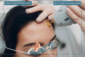 لیزر موهای زائد پیشانی: عوارض، قیمت و مزایا
