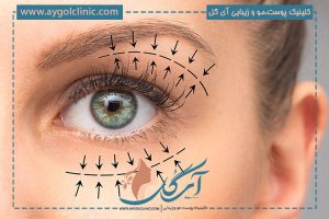 علت گود شدن زیر چشم بعد از بلفاروپلاستی و راهکارهای رفع آن