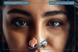 بررسی قرینه نبودن چشم بعد از عمل پلک و روش های درمان آن