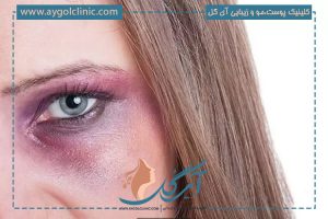 بررسی رفع کبودی دور چشم بعد از عمل پلک و مراقبت های آن