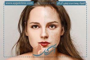 رفع کک و مک پوستی با لیزر با بهترین دستگاه ها در کلینیک آی گل