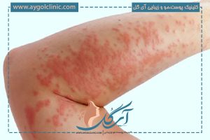 ضایعه کهیر پوستی با ظاهری قرمز و برجسته معروف به راش