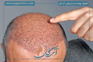 جلوگیری از نکروز در کاشت مو: علل، پیشگیری و درمان موثر